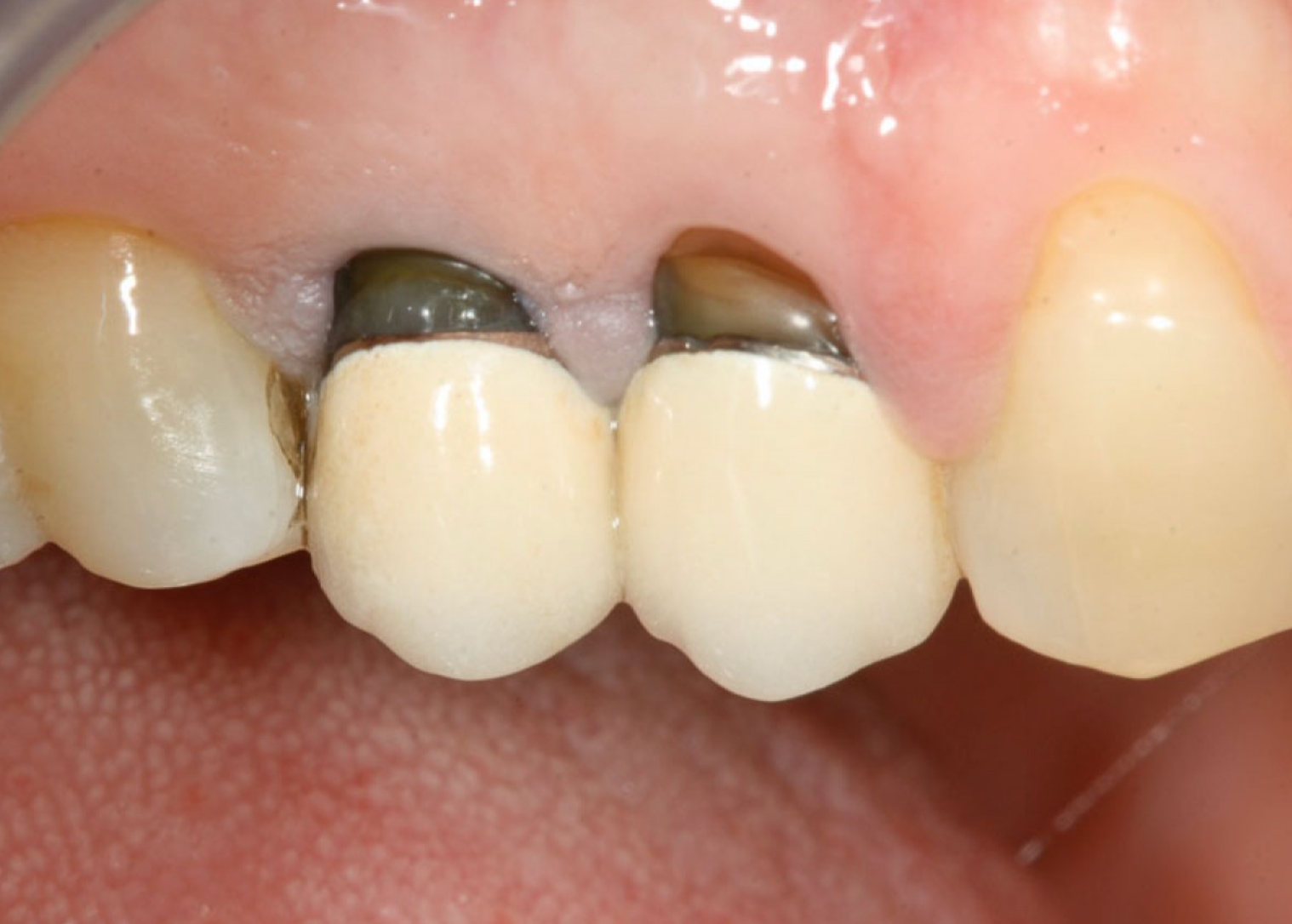 Fase 1: la progettazione implantare. Caso clinico del dott. Massimo Fagnani