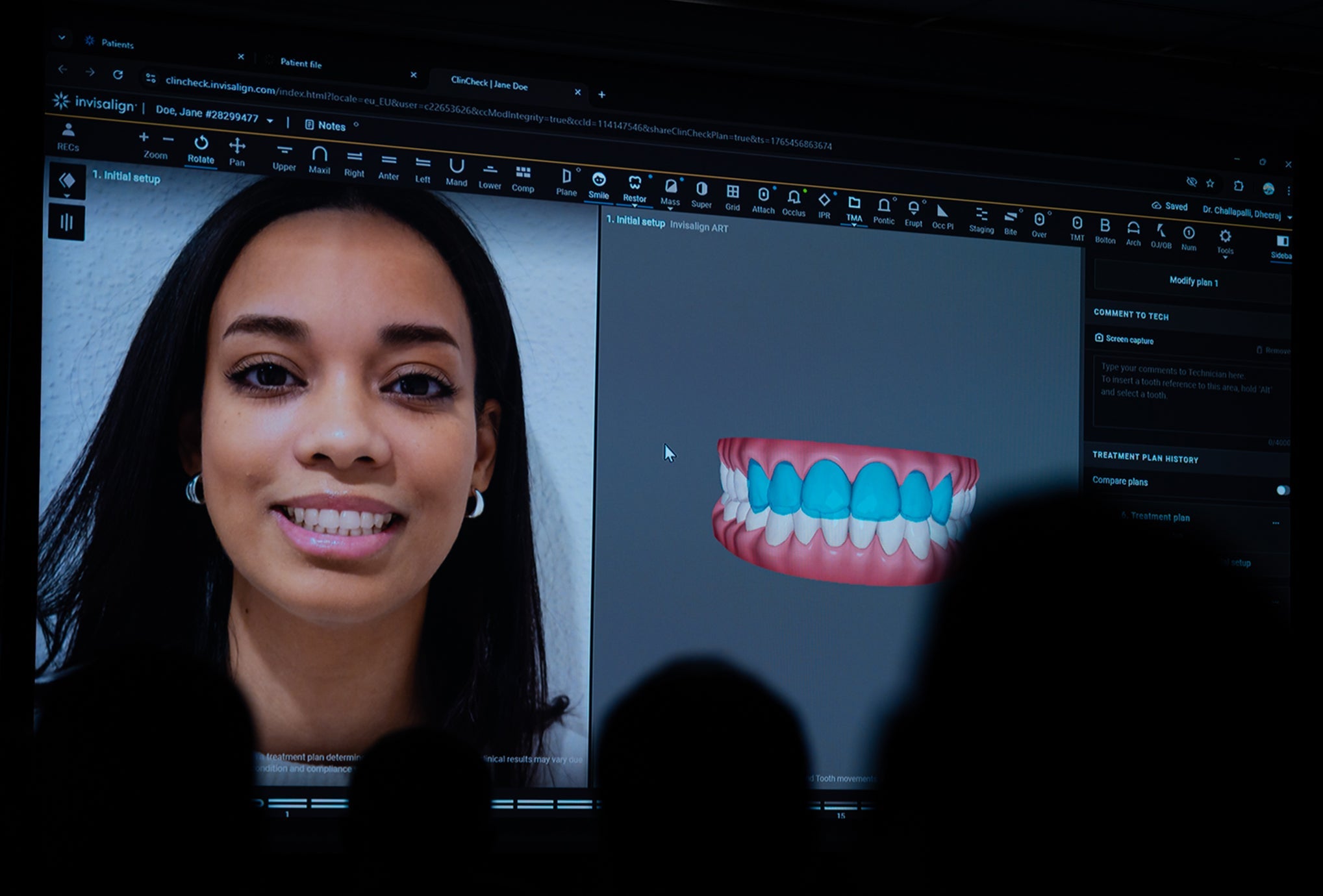 Align Technology e IDI Evolution: integrazione dell’allineamento dentale pre-protesico nell’odontoiatria restaurativa