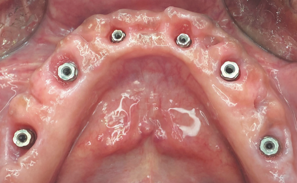 Tecnologia per perio-implanto-protesi a ridotto impatto biologico: progettazione virtuale e impianti B1ONE