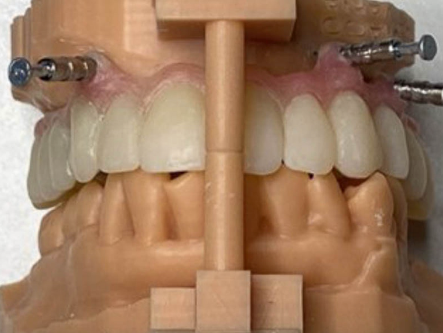 Il caso del Dott. Monaco con protesi provvisoria di lunga durata a carico immediato