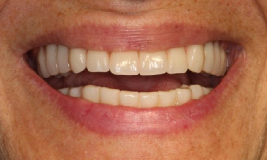 Caso clinico ‘Full Arch’ con B1ONE