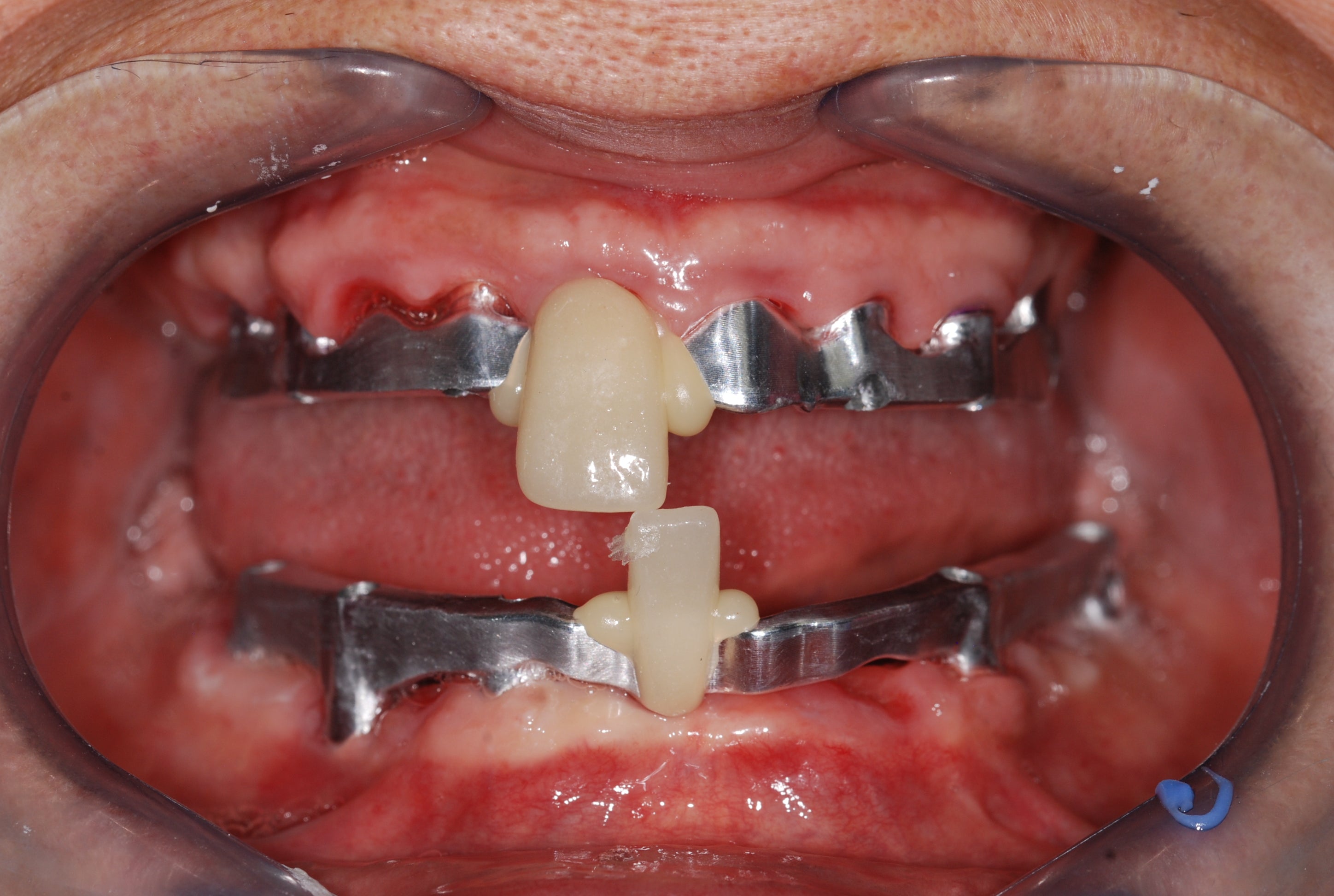 Il ripristino digitale della Dimensione Verticale di Occlusione in caso di riabilitazioni fisse su impianti con la tecnica Vertical Box: case report
