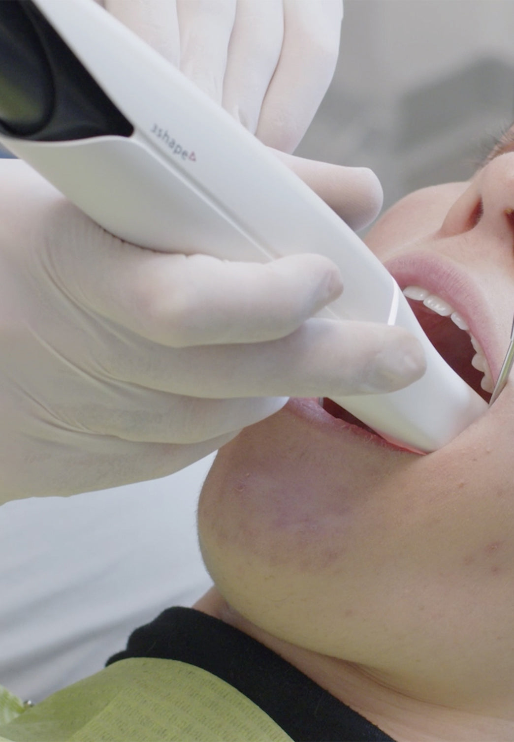 scansione trios by 3Shape scanner intra-orale