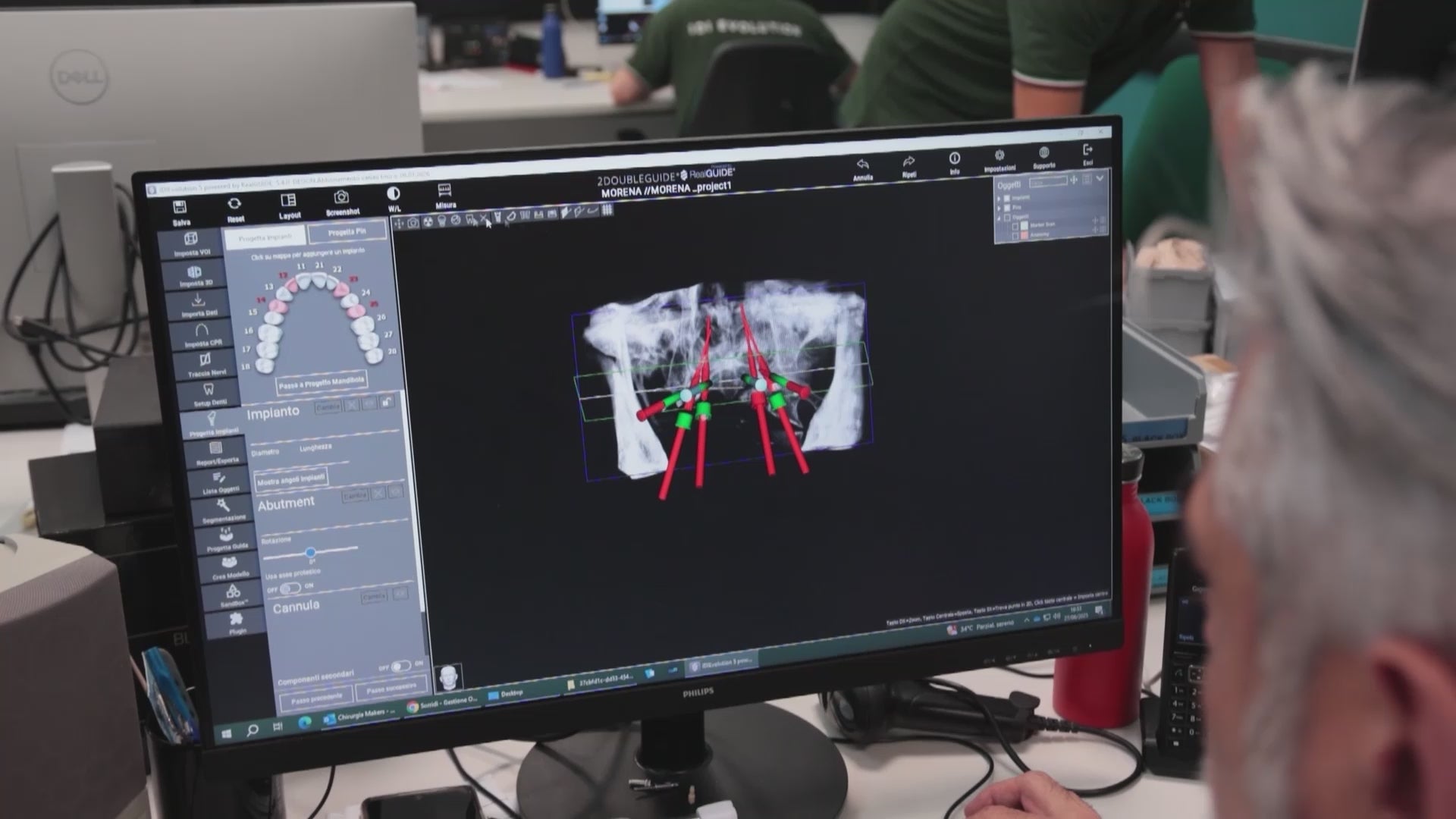 Carica il video: 2doubleguide software chirurgia guidata