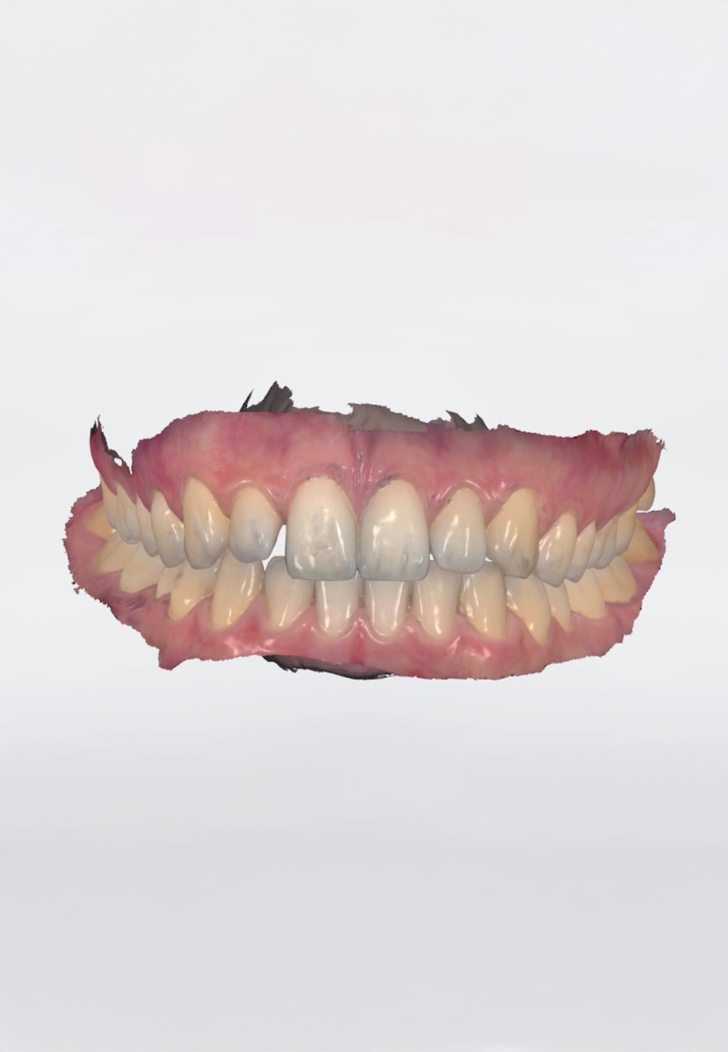 scansione trios by 3Shape scanner intra-orale