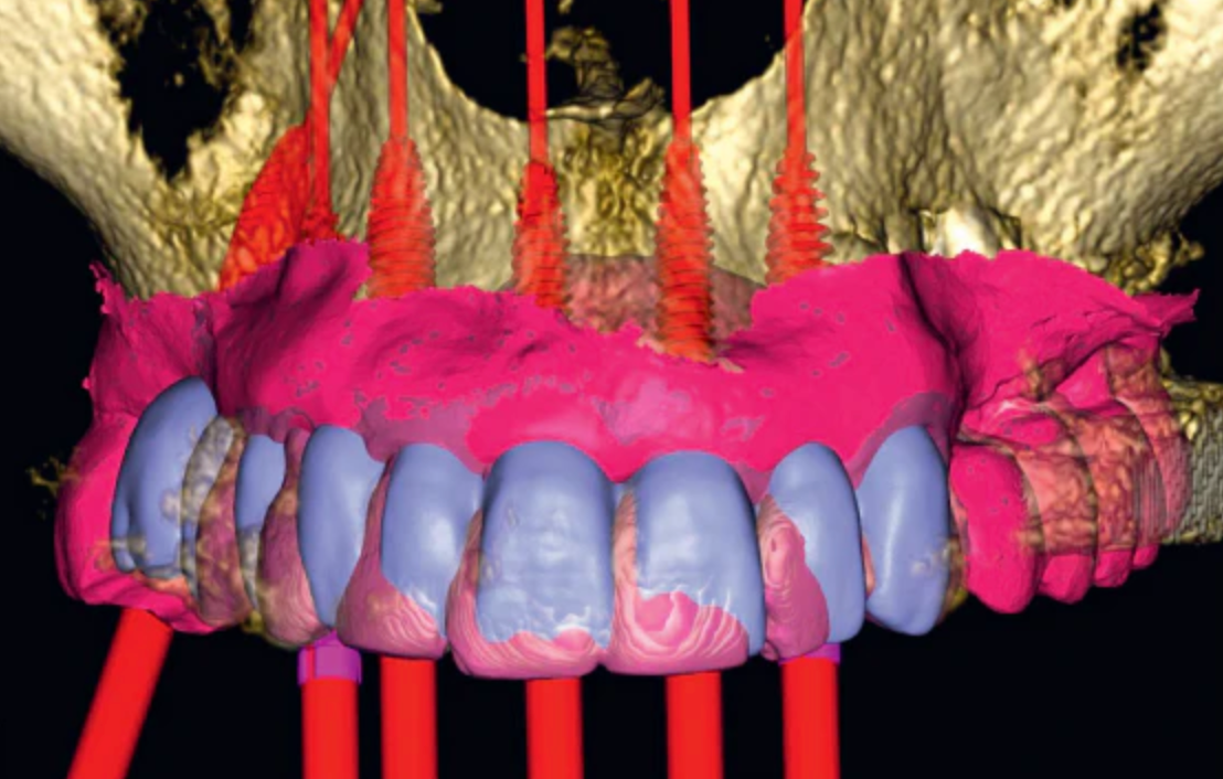 Chirurgia guidata con dime in titanio: tecnologia per l’evoluzione