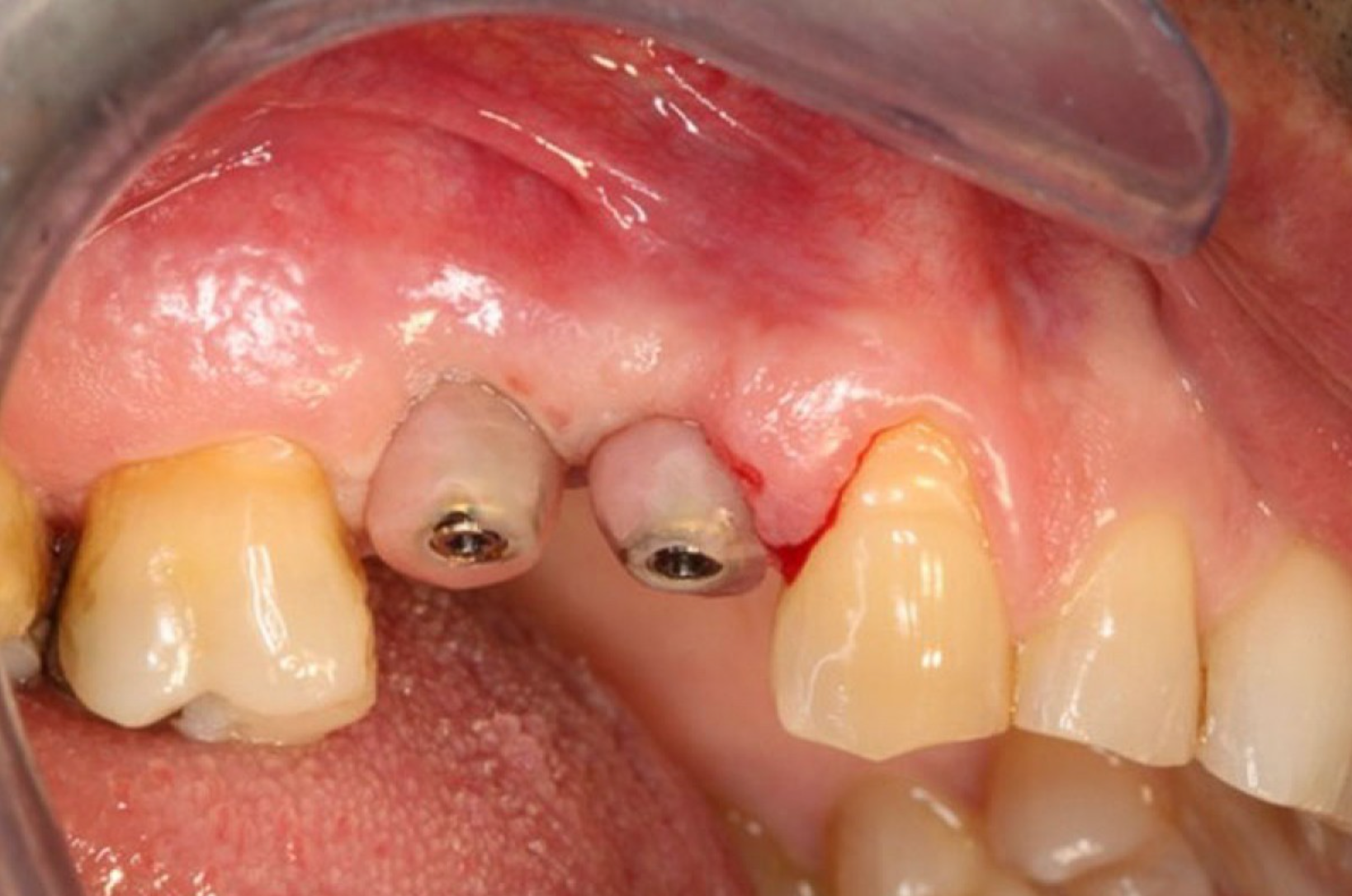 Fase 2: esecuzione chirurgica e finalizzazione. Caso clinico del dott. Massimo Fagnani