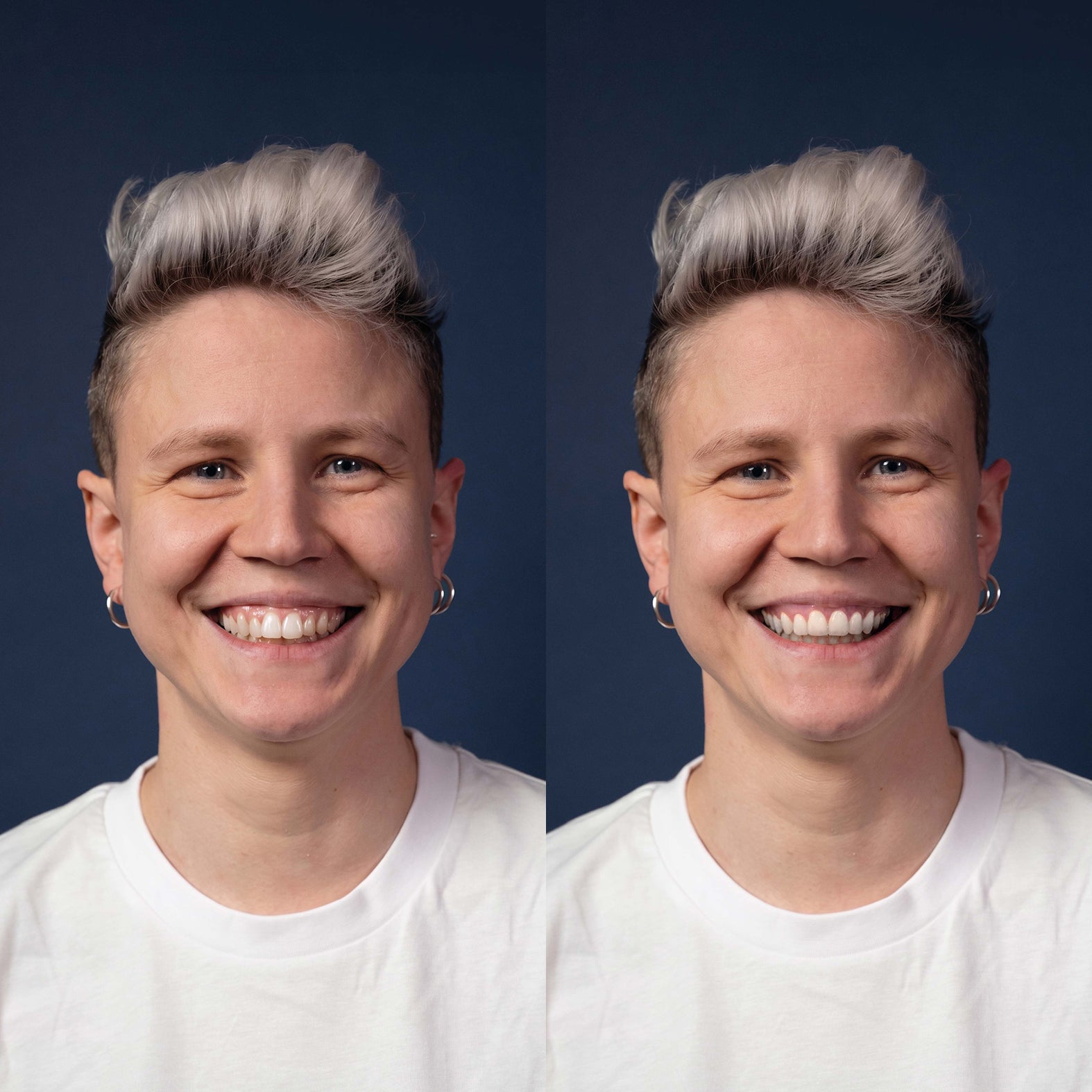 Invisalign® ART
