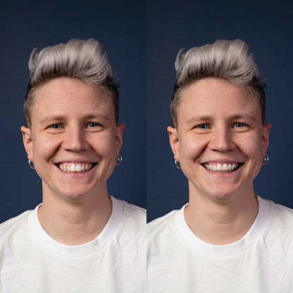 Invisalign® ART
