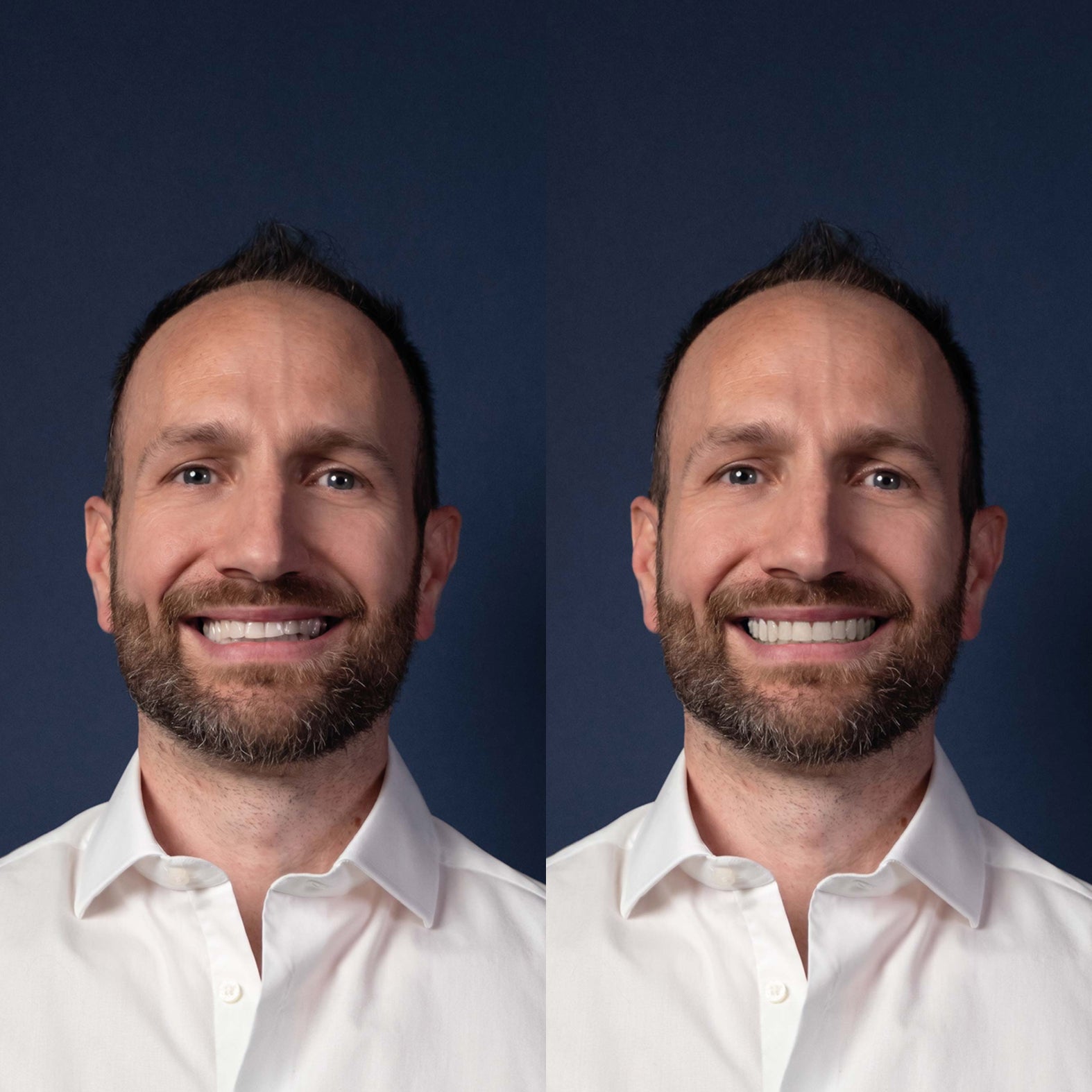 Invisalign® ART