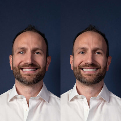 Invisalign® ART
