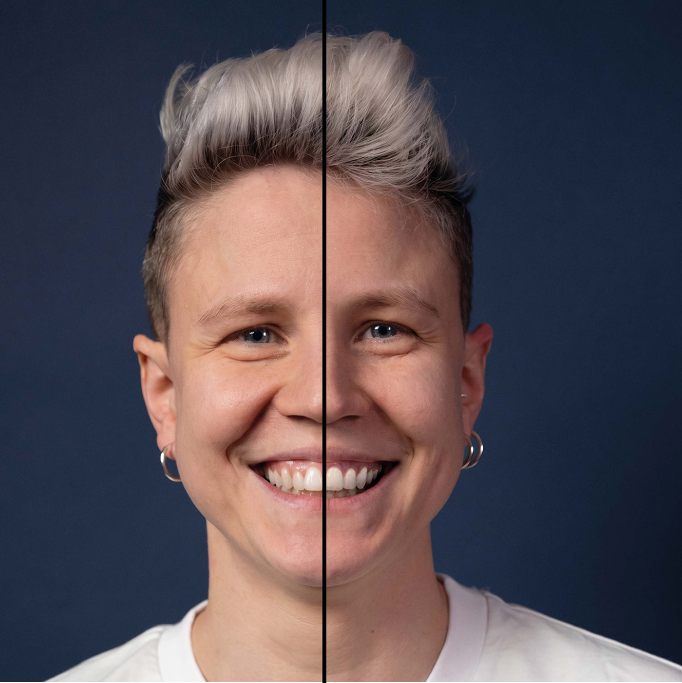 Invisalign® ART