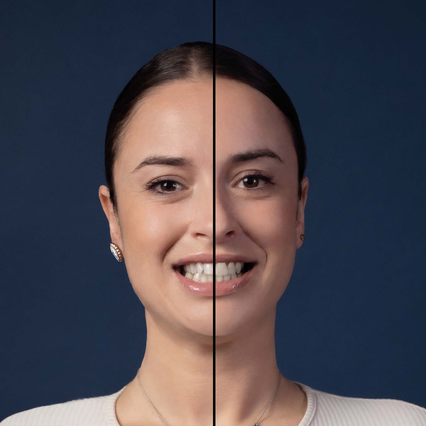 Invisalign® ART