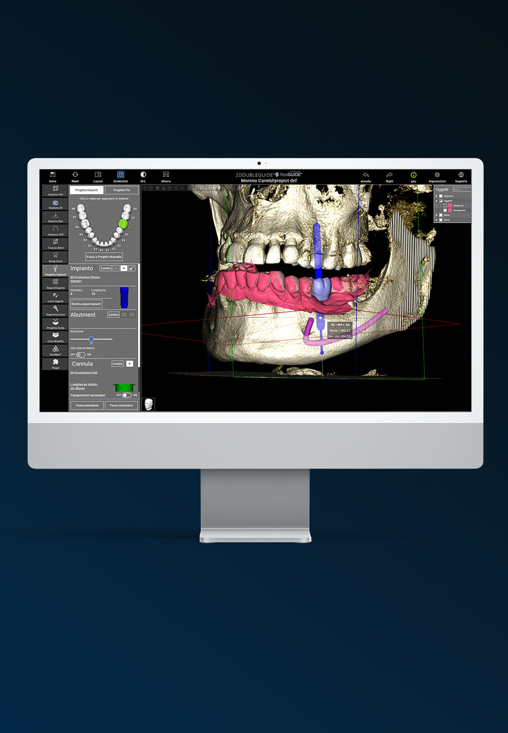 Progetto implantare software 2doubleguide