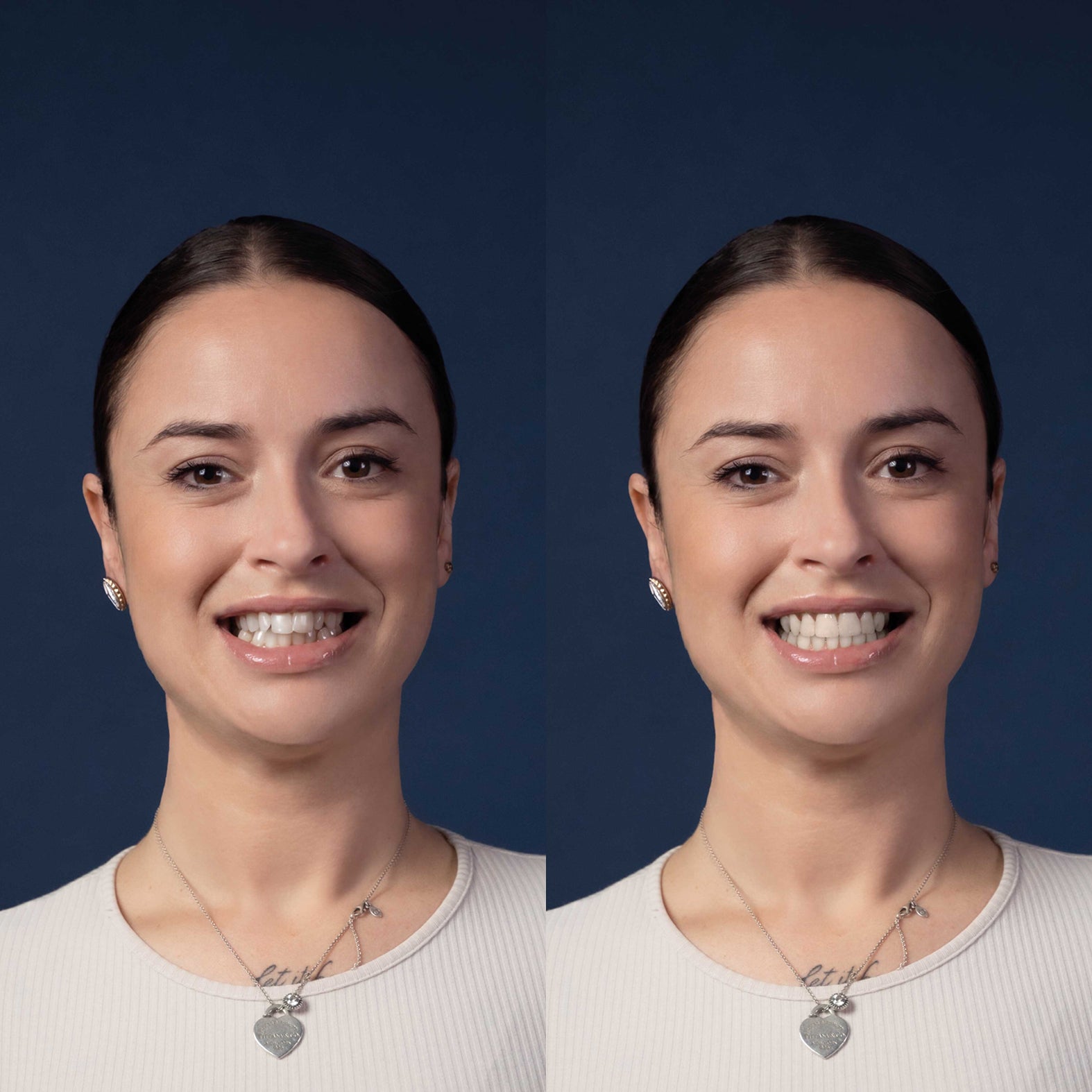 Invisalign® ART
