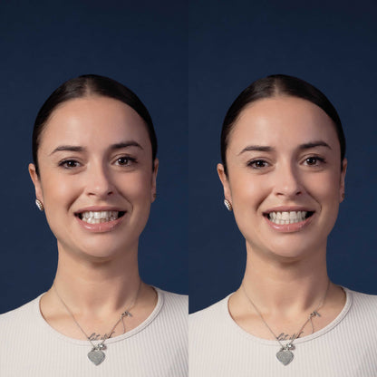 Invisalign® ART