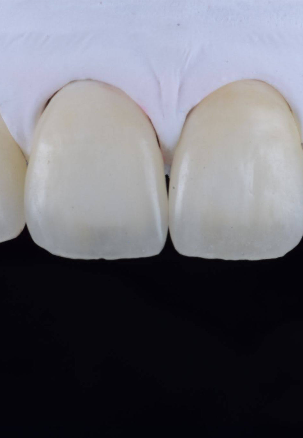 faccette dentali